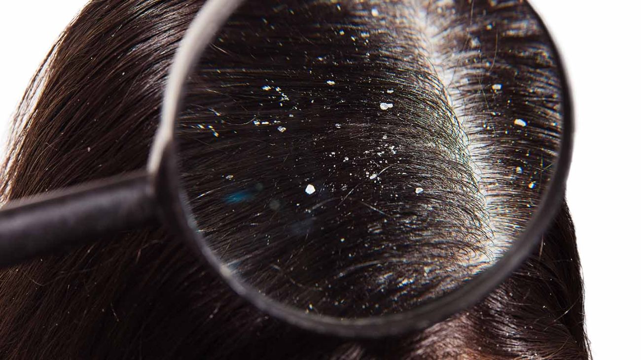 magnifying glass focused on a person’s flaky scalp